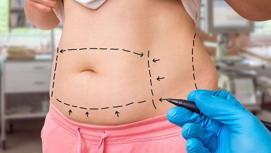 Liposuction: Benefits, Uses, and everything that you should know