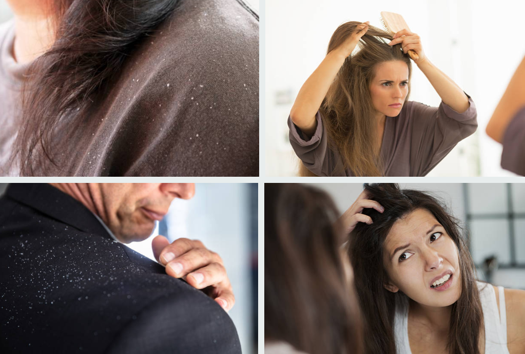 Get Rid Of Dandruff With These Handy Tips!